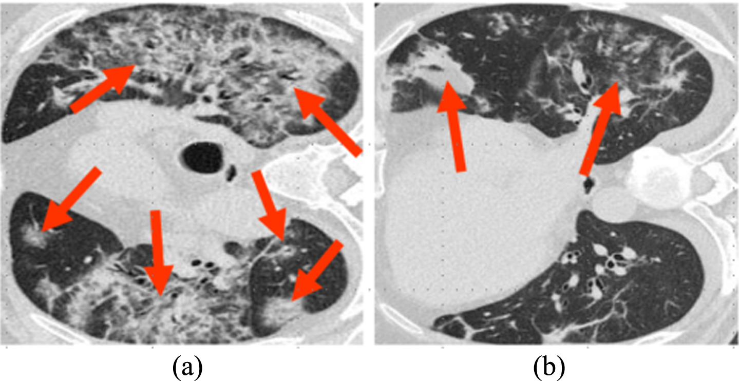 COVID-19 CT scans with complex appearances of infection lesions. The two examples are from different COVID-19 patients. The areas pointed by red row is infected by COVID-19.