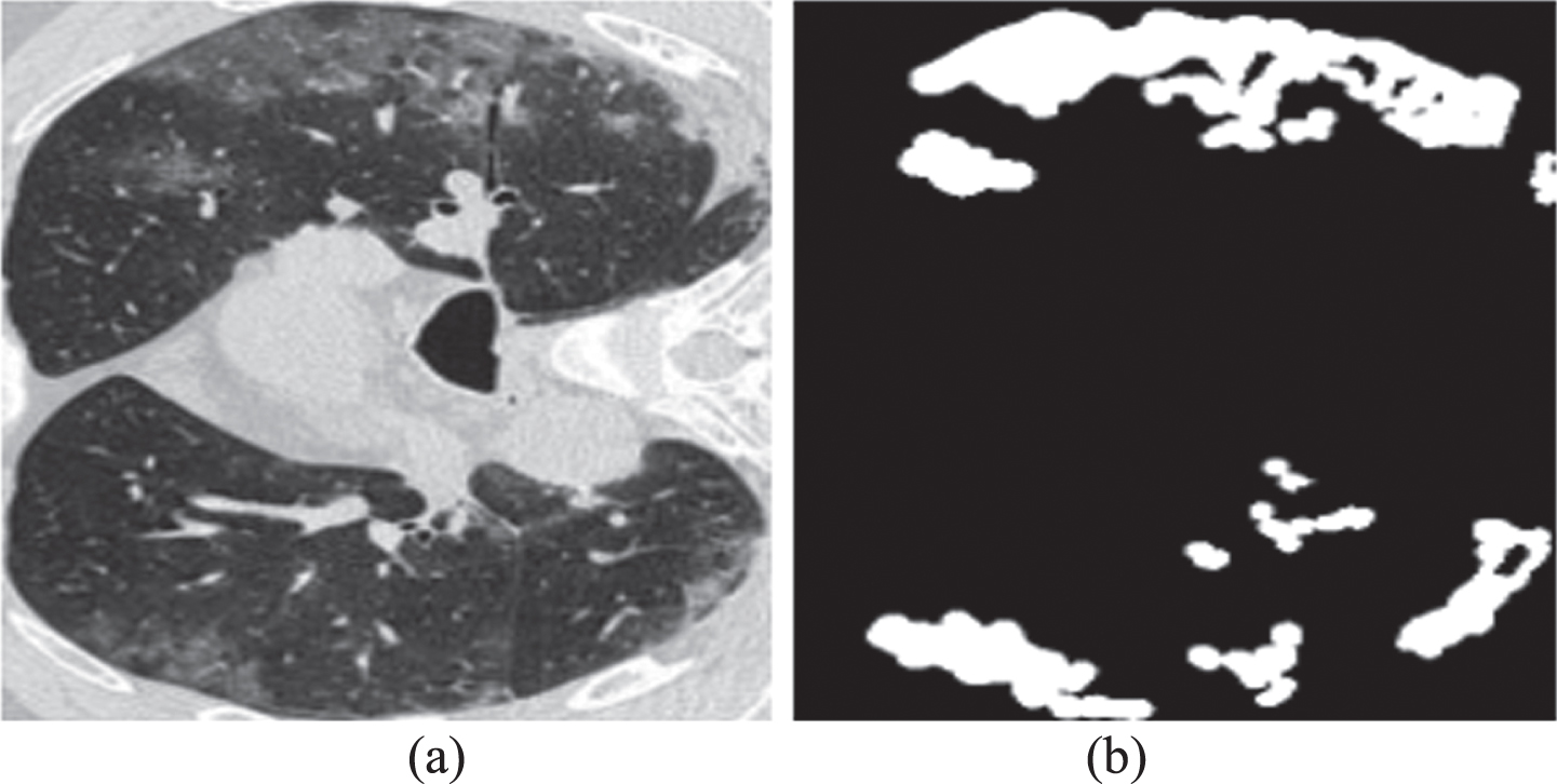 Example of COVID-19 CT image and its annotated label. (a) a CT image of the dataset; (b) its corresponding COVID-19 lesion label annotated by a senior radiologist.