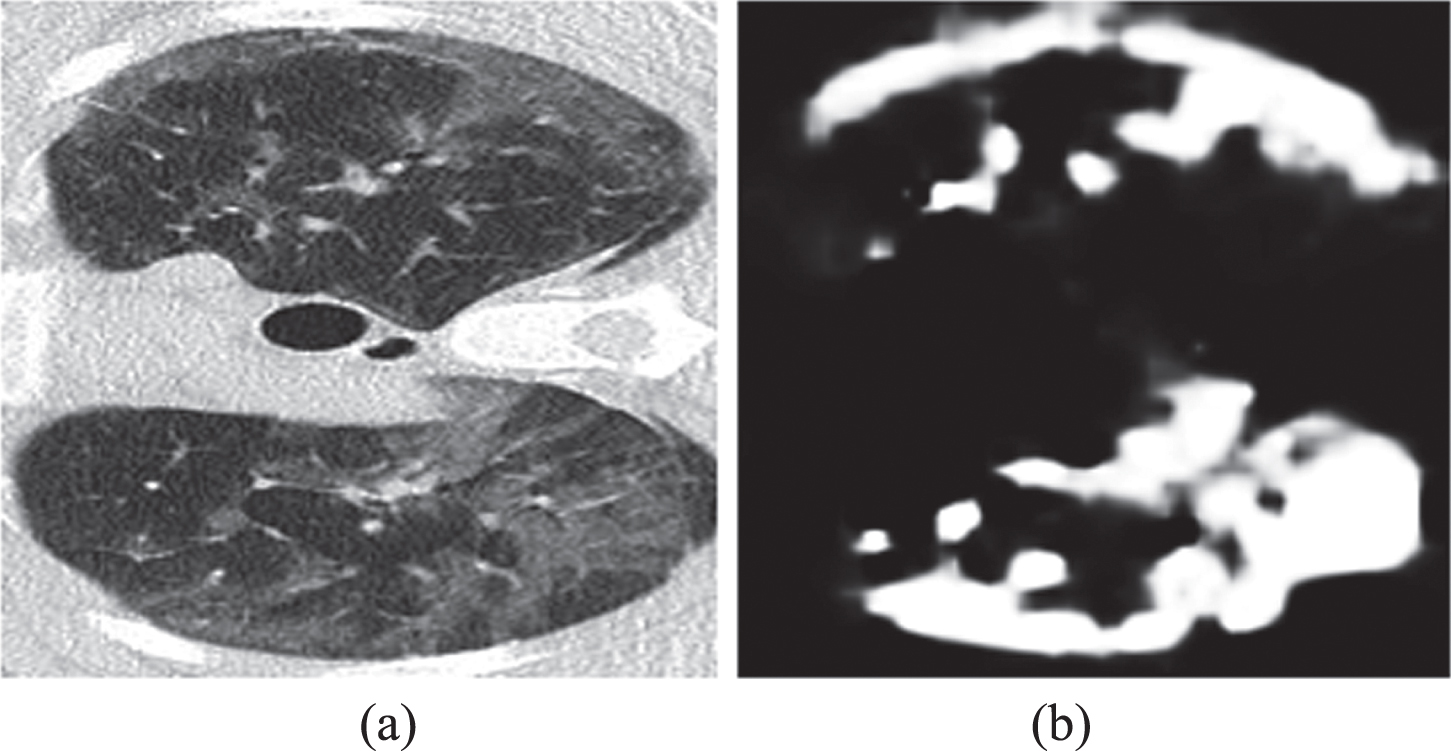 An example of CT image and its pseudo label from the pseudo label dataset provided by Fan et al. (a) a CT image of the pseudo label dataset; (b) its corresponding pseudo label.