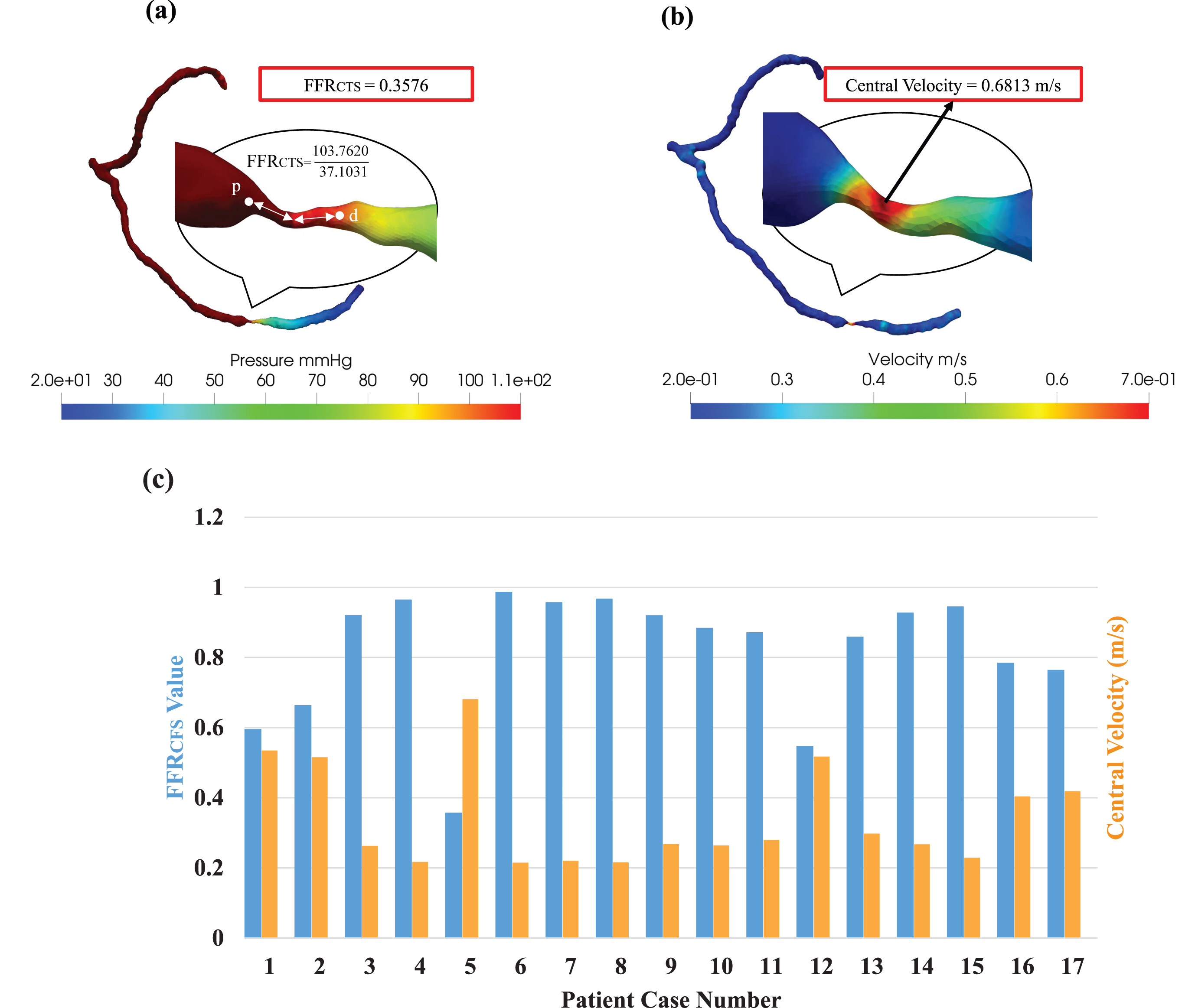 (a) Fractional flow reserve derived from computational tomography simulation (FFRCTS) and (b) central velocity mapping in Severe Stenosis patient. (c) probing the complex relationship between FFRCTS and central velocity in various clinical scenarios.