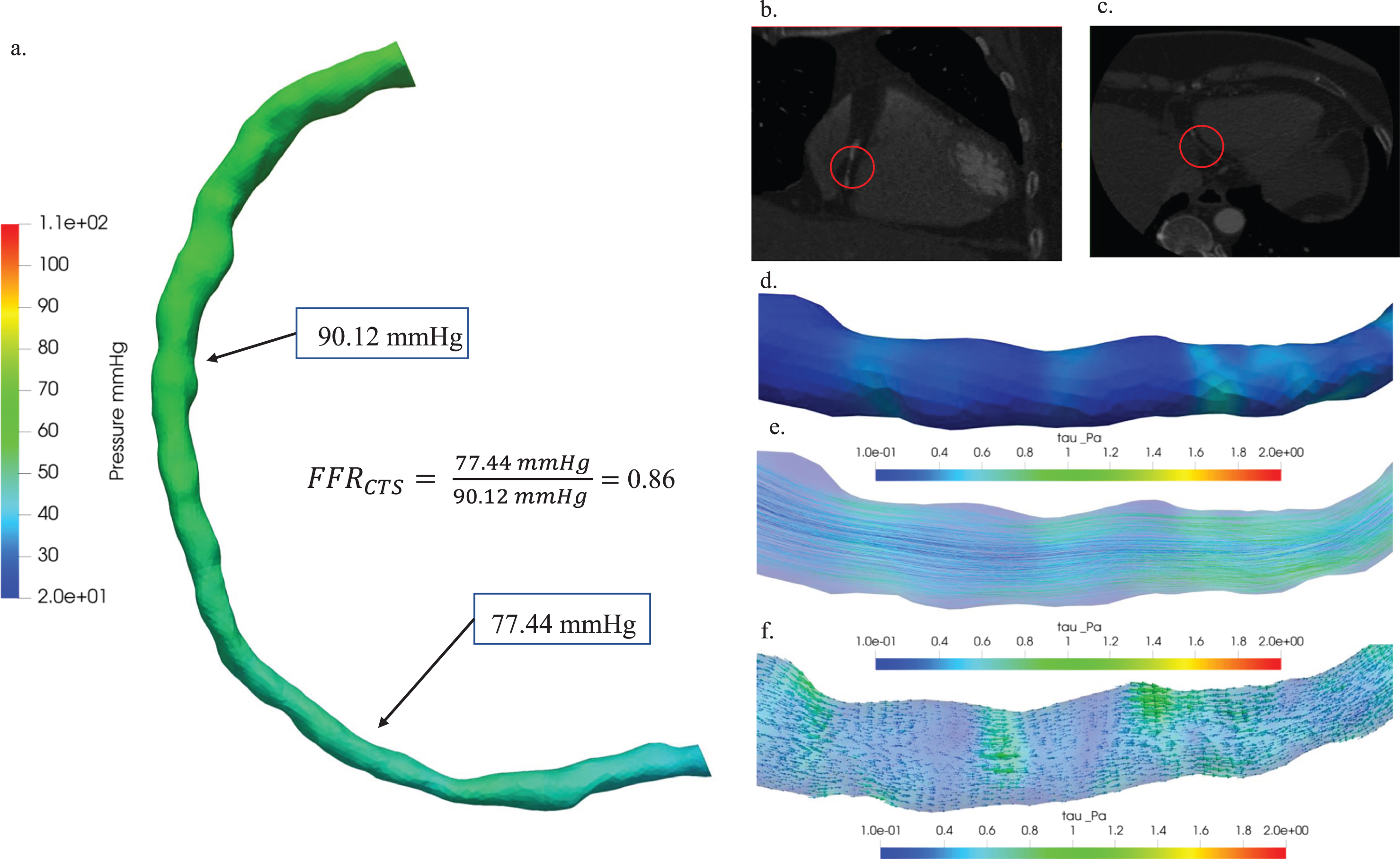 Hemodynamic characterization of stenosis in patient Case 13: (a) A comparative study of pressure distribution and FFRCTS value, (b) 3D visualization of blood vessel CT images: axial view (b) and coronal view (c), plaque locations highlighted with red circles. Hemodynamic visualization of wall shear stress (d), streamline (e), and vector (f).