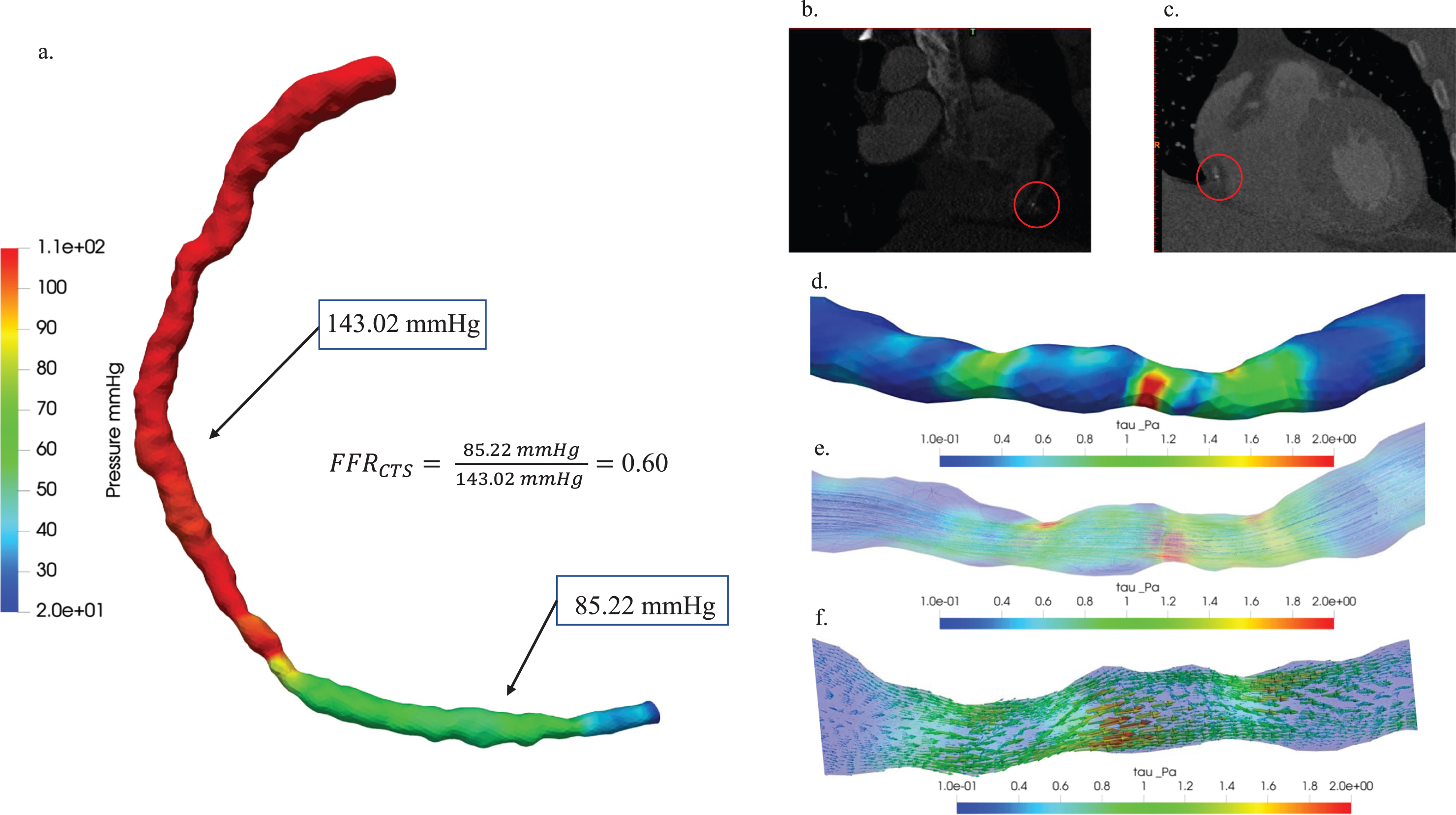 Hemodynamic characterization of stenosis in patient Case 1: (a) A comparative study of pressure distribution and FFRCTS value, (b) 3D visualization of blood vessel CT images: axial view (b) and coronal view (c), plaque locations highlighted with red circles. Hemodynamic visualization of wall shear stress (d), streamline (e), and vector (f).